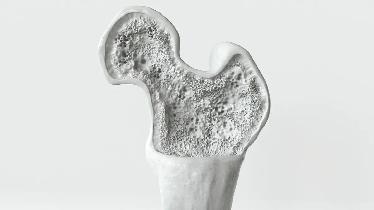 پوکی استخوان